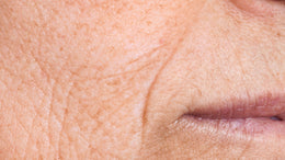 Fine lines & Wrinkles