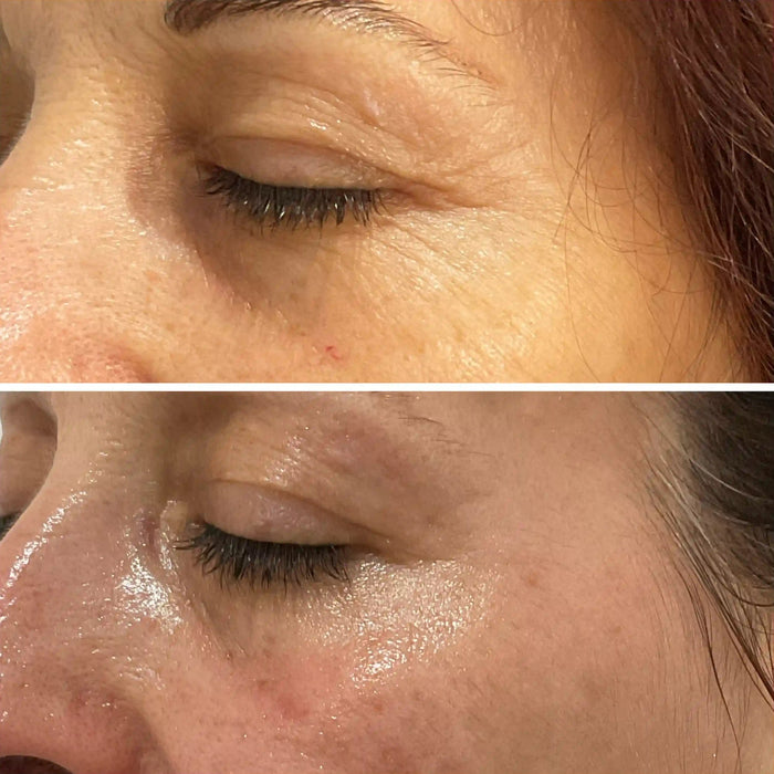 Wrinkles have Disappeared