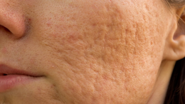 Post Acne Marks