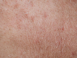 Dull Skin